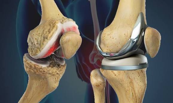 What’s Next for Revision Total Knee Arthroplasty in Patient-Centered Care?